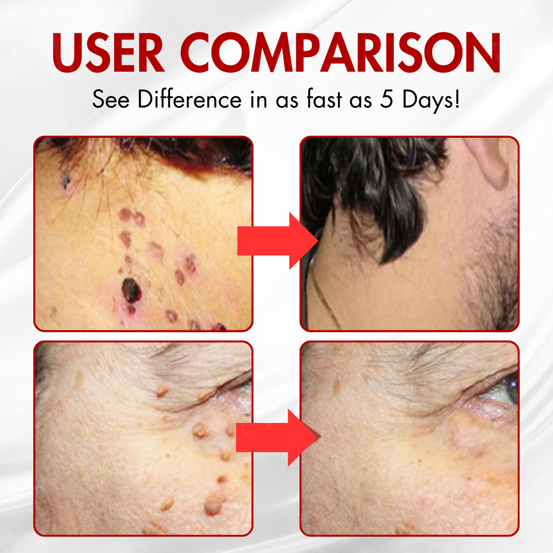 AEXZR® Nano-Microdart Skin Tag & Spot Corrector Patches🎯 Clear Skin, No Clinic Needed 🎯
