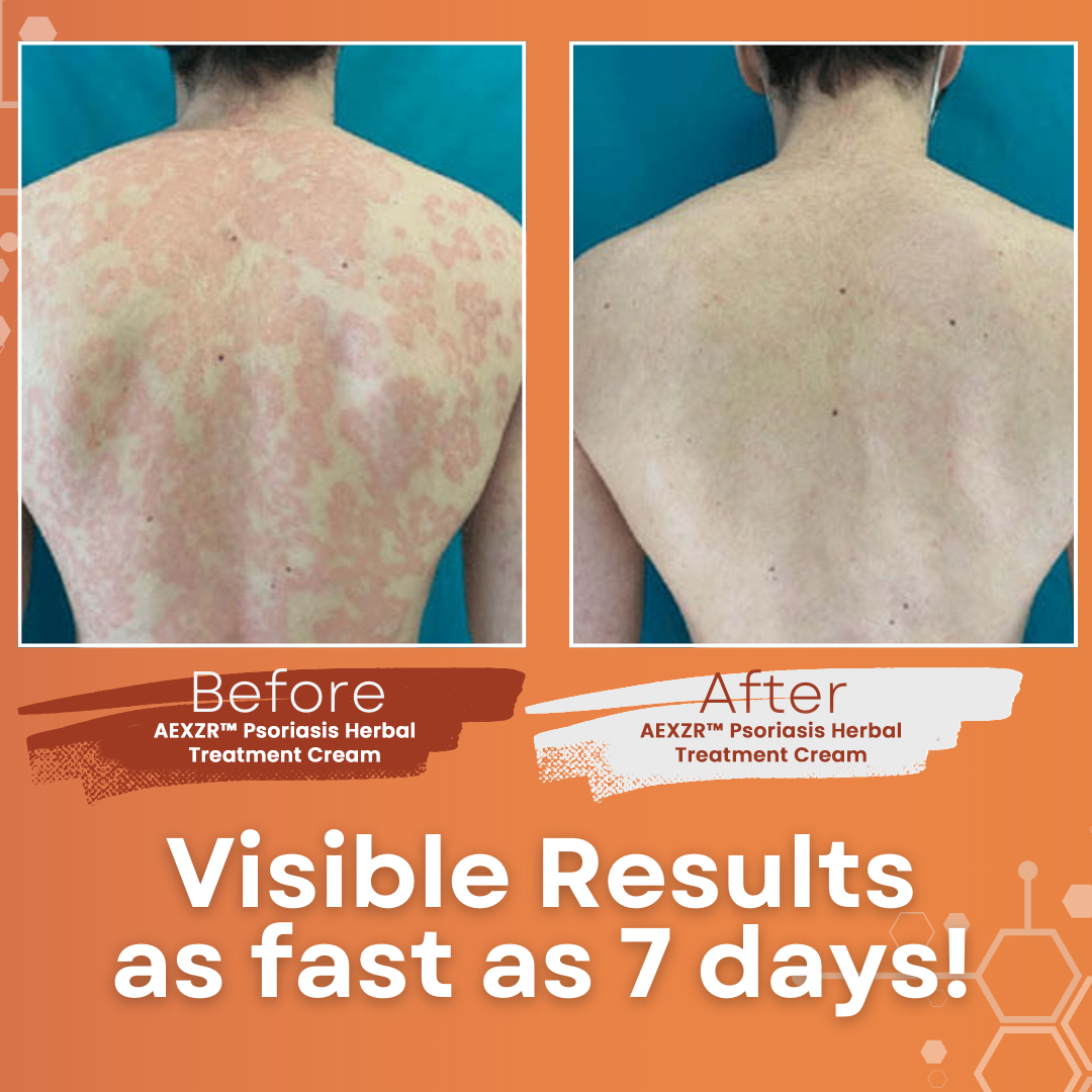 AEXZR™ Psoriasis Herbal Treatment Cream🧬 Dermatologist-Developed Biome Repair: Targets The Root Cause For 93% Reported Skin Recovery.