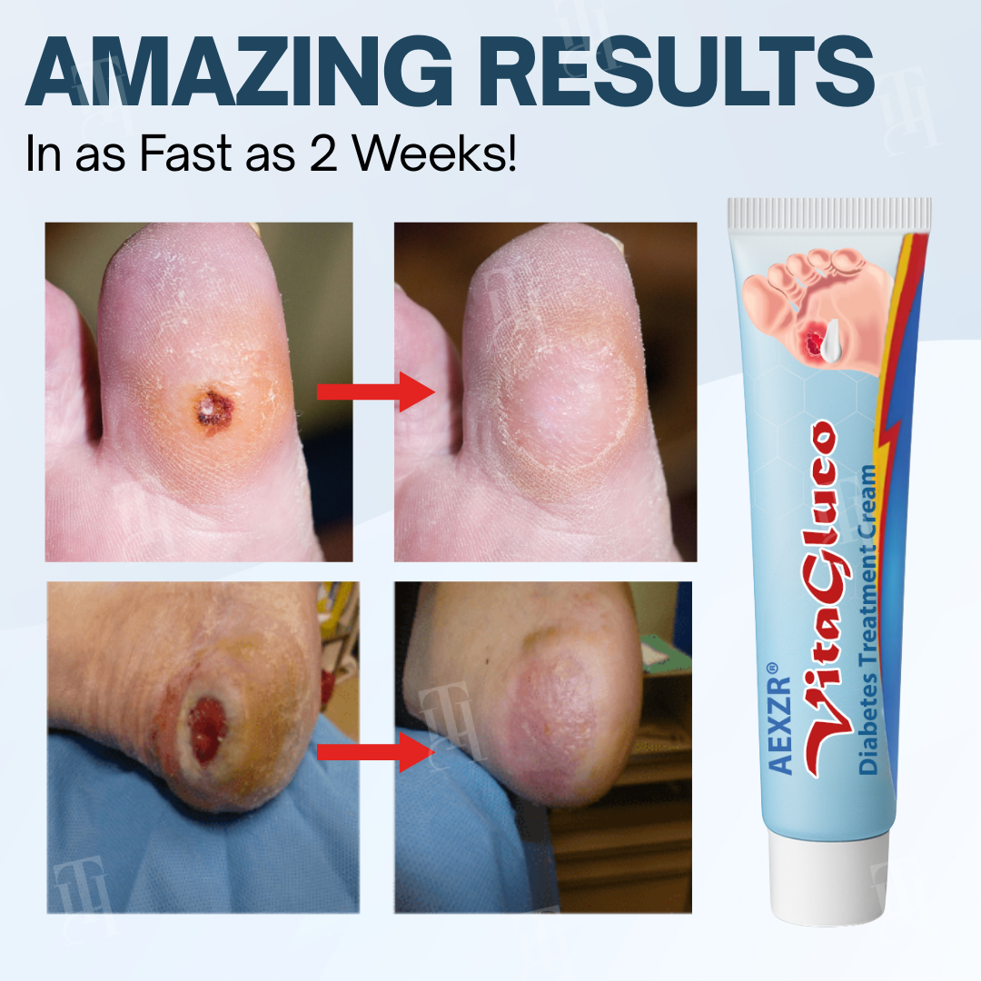 AEXZR® VitaGluco Diabetes Treatment Cream✨ The Circulation-Reactivation Cream: Heals Stubborn Ulcers & Balances Blood Sugar Naturally.