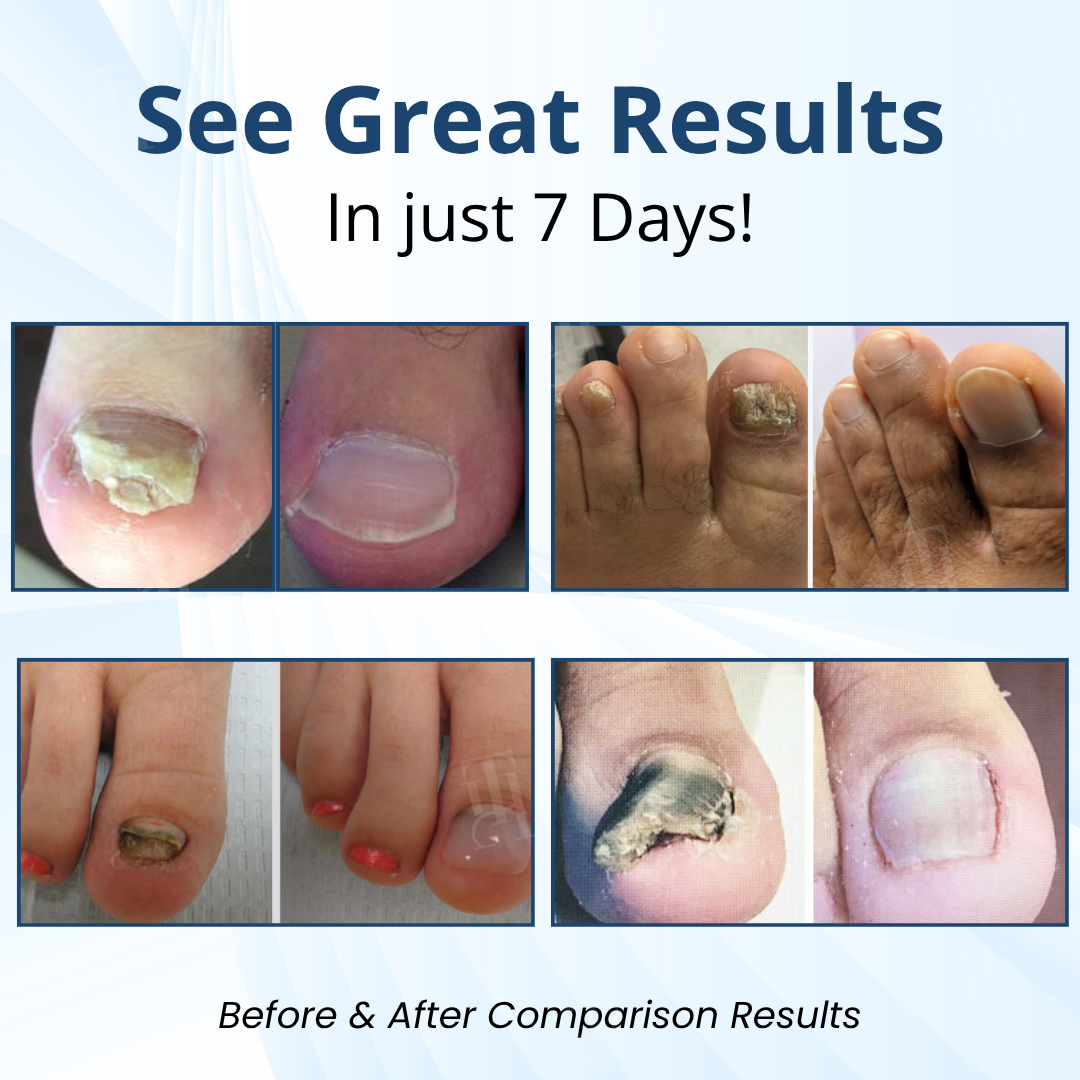 AEXZR® MycoShield Pro Fungal Nail Patches🧪 The Hydrogel Occlusion Breakthrough: Melts Through the Keratin Wall in 2 Nights for Deeper Repair.