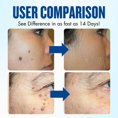 AEXZR® Advanced Skin Tag Protocol Cream