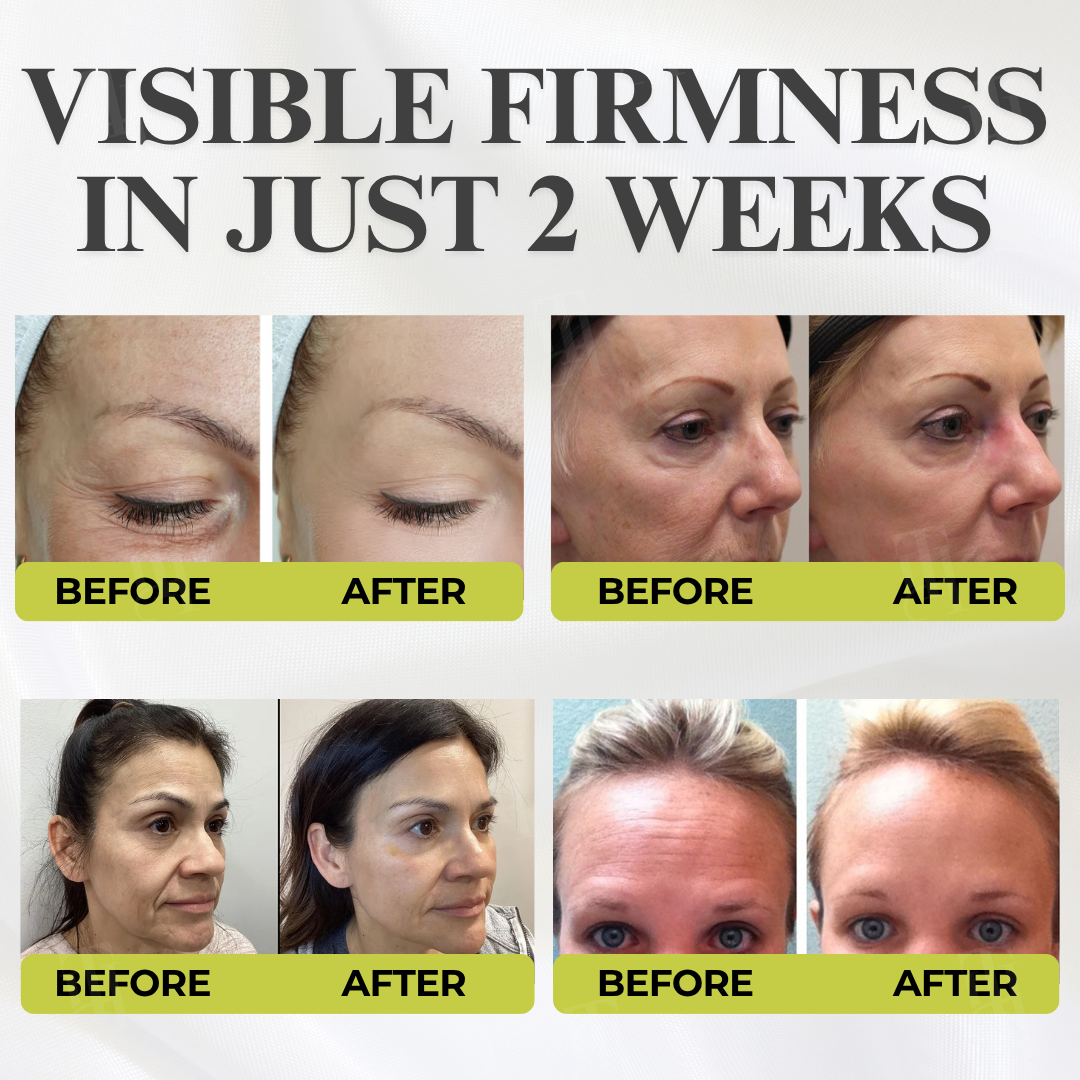 AEXZR® Botox & Vita-A Retinol Shot Wrinkle - Lift Tightening Cream ✨ The Micro-Infusion Revolution: Fills & Smooths Wrinkles at The Source for a 10-Year-Younger Look.