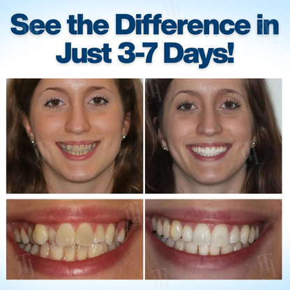 AEXZR® WhitenEase Pro Whitening Pen🌟 The Smile Revolution Starts Here