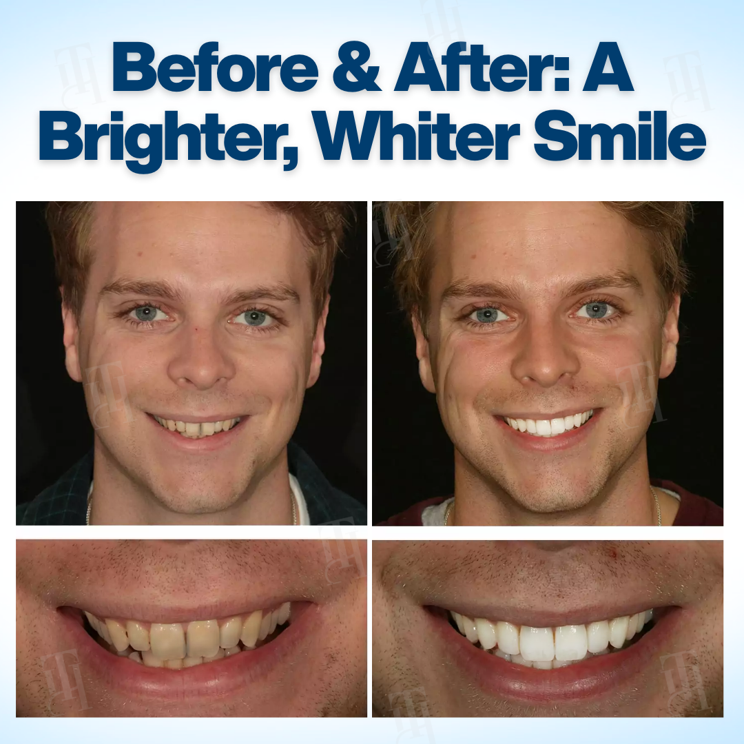 AEXZR® WhitenEase Pro Whitening Pen🌟 The Smile Revolution Starts Here