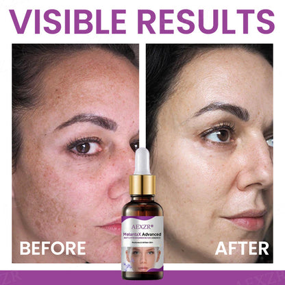 AEXZR® MelantaX Advanced Anti-Hyperpigmentation Essence✨ Spot-Fade in 2 Weeks
