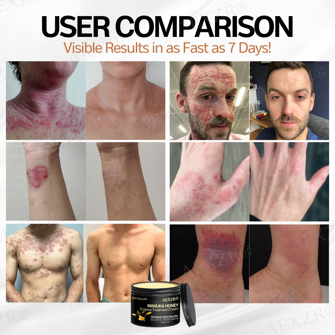 AEXZR® New Zealand Manuka Honey Eczema Treatment Cream🎯 Soothe the Rage, Reclaim Your Skin