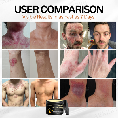 AEXZR® New Zealand Manuka Honey Eczema Treatment Cream🎯 Soothe the Rage, Reclaim Your Skin
