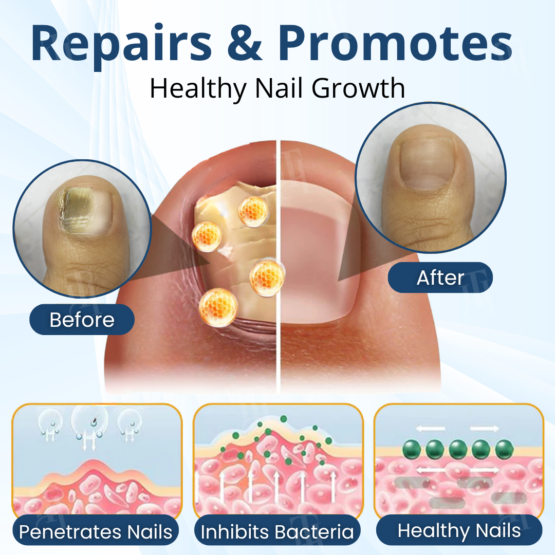 AEXZR® MycoShield Pro Fungal Nail Patches🧪 The Hydrogel Occlusion Breakthrough: Melts Through the Keratin Wall in 2 Nights for Deeper Repair.