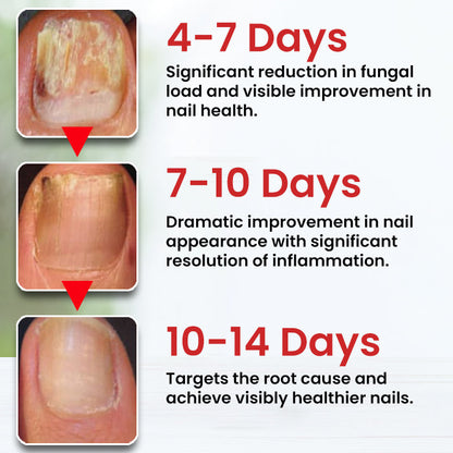 Dobshow® Fungi-Cure Max 🎯 Triple-Action Formula: Penetrates Deep to the Nail Root, Eradicates Fungus & Restores Healthy Growth