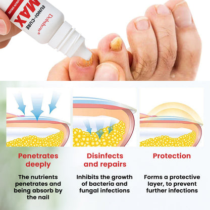 Dobshow® Fungi-Cure Max 🎯 Triple-Action Formula: Penetrates Deep to the Nail Root, Eradicates Fungus & Restores Healthy Growth