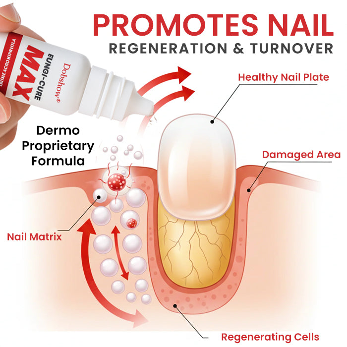 Dobshow® Fungi-Cure Max 🎯 Triple-Action Formula: Penetrates Deep to the Nail Root, Eradicates Fungus & Restores Healthy Growth