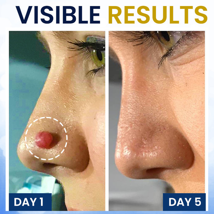🥚 Easter Deal AEXZR® Skin Tag Cryo Treatment Spray🧊 Precision Cryo-Tech: Freezes Away Skin Tags & Warts in Seconds – No Blades, No Pain.